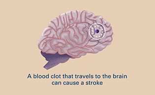 A blood clot that travels to the brain can cause a stroke.